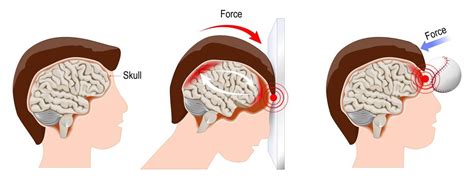Concussion Brain Compared To Normal