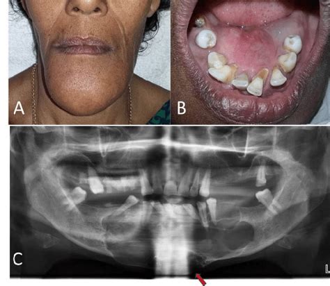 A Clinical Photograph Showing Swelling In The Anterior Mandibular