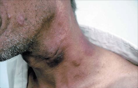 Cervical Lymph Node And Skin Aspect After 40 Days Of Treatment