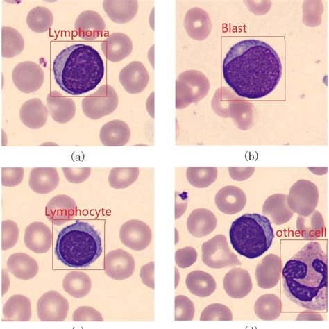 Lymphoma A Blast B Lymphocyte C And Other Cell D Download