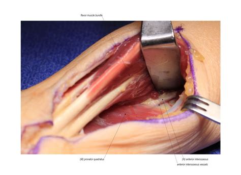 Anterior Interosseous To Ulnar Motor Reverse End To Side Nerve
