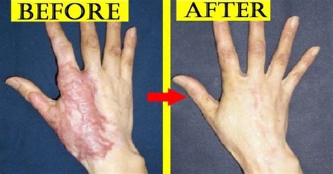 How To Heal Burn Scars Quickly Heal Mania