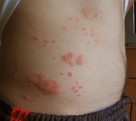Rash On Stomach Pictures Treatment Symptoms Causes Hubpages