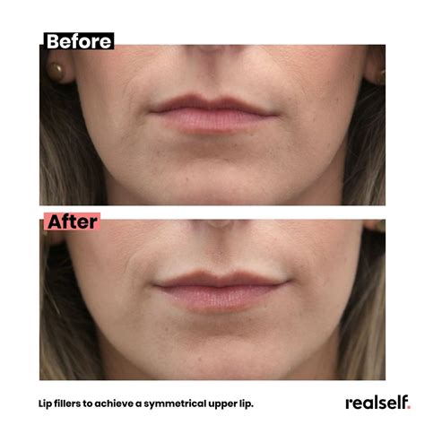 Juvéderm Filler Everything You Need To Know Realself Juvederm