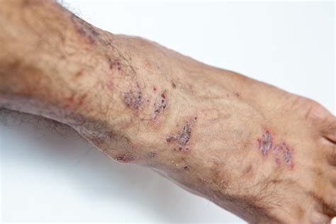 Venous Eczema Causes Treatments And Prevention Auckland Nz Palm