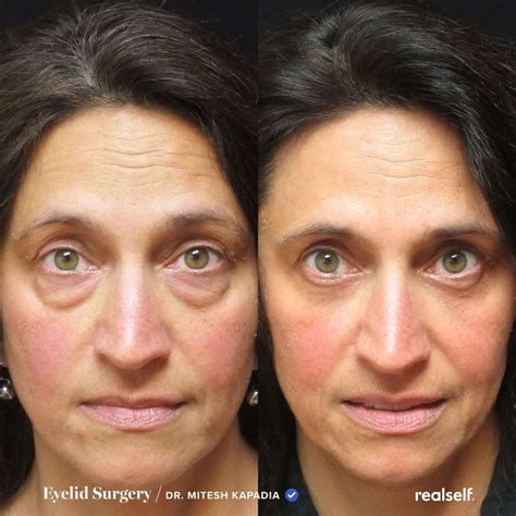 Famous Surgery For Under Eye Bags Before And After 2022