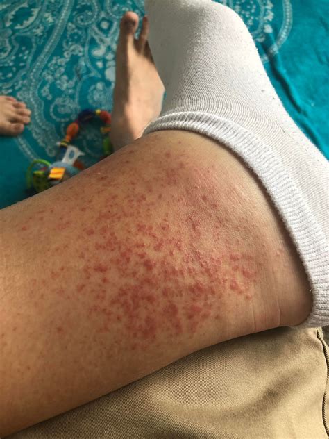 Not Quite Popping Just Yet But Can Anyone Shed Any Light On This Rash
