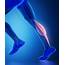 Tennis Leg Strained Calf Muscle Treatment  Charschan Chiropractic