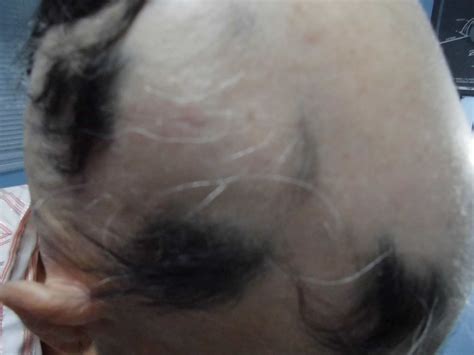 Caso N Ed Alopecia Areata Multifocal Piel L Latinoamericana