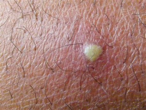 White Bumps On Scrotum Hair Follicles Pilar Cyst Causes Treatment And