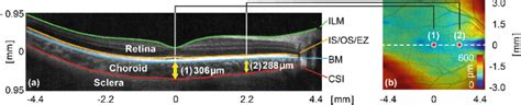 A Oct B Scan With Segmented Layers Corresponding To The White Dotted