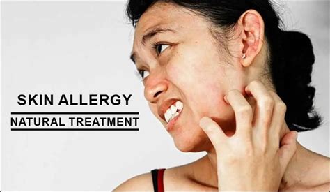 5 Ways To Treat Your Skin Allergy Naturally Ayurvedic Treatment