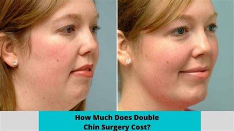 Double Chin Surgery Cost Updated 2024