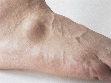 Ganglion Cyst On Foot Pictures Cause Symptoms And Treatment