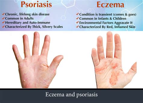 What Are The Differences Between Eczema And Psoriasis Psoriasis Expert