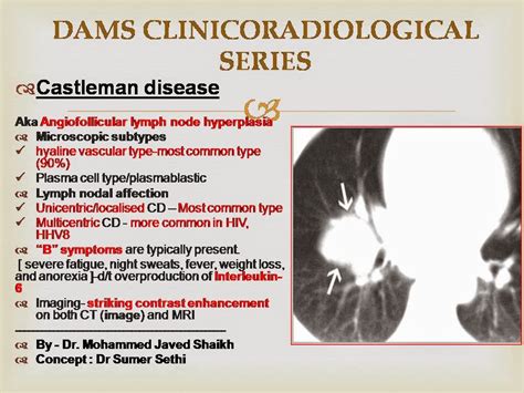 Castlemans Disease Clinicoradiological Series Sumers Radiology Blog