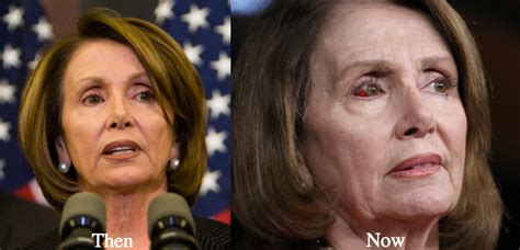Maybe you would like to learn more about one of these? Nancy Pelosi Plastic Surgery Before and After Photos ...