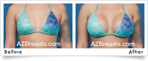 how to choose breast implant size ademploy19