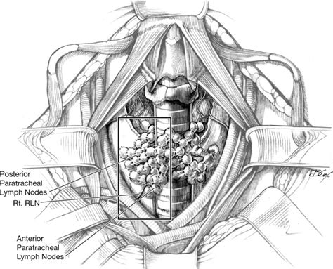 Central Compartment Lymph Node Dissection Operative Techniques In