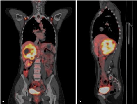 Pet Ct Scan Tumor Of The Right Adrenal Gland With Intense Fdg Uptake