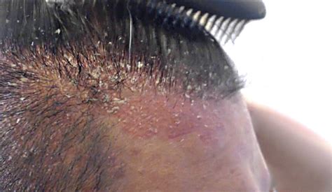 Come curare la dermatite seborroica - Centri Tricologici ...