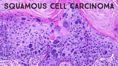 Squamous Cell Carcinoma In Situ With Massive Pleomorphism Pathology Dermpath Dermatology Usmle