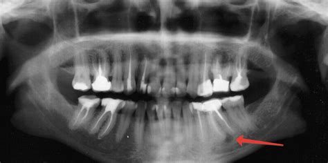 Treatment Of A Tooth Cyst Digital Dentistry Clinic Siy Dental