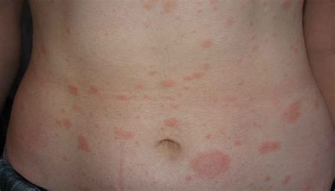 Сыпь на животе у взрослого мелкая красная при аллергии и дерматите а