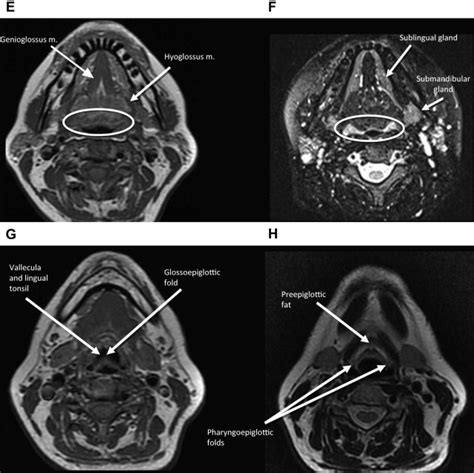 Pitfalls In The Staging Of Cancer Of The Oropharyngeal Squamous Cell