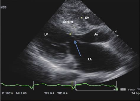 2d Transthoracic Echocardiography Asymmetric Lv Hypertrophy Septal To