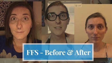 FFS Before After 7 Weeks Post Op MTF Transgender I Facial