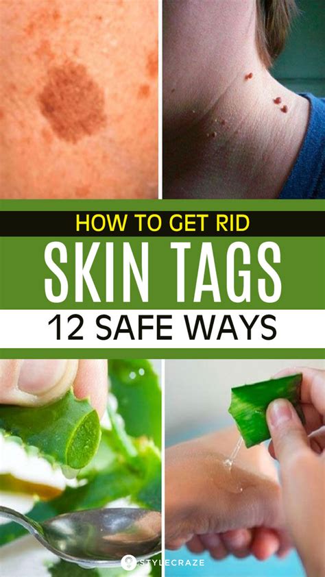 12 home remedies to remove skin tags naturally natural health remedies natural cough remedies