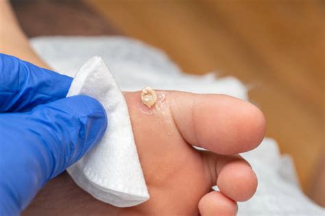 Plantar Wart Symptoms Causes And Treatment Repc
