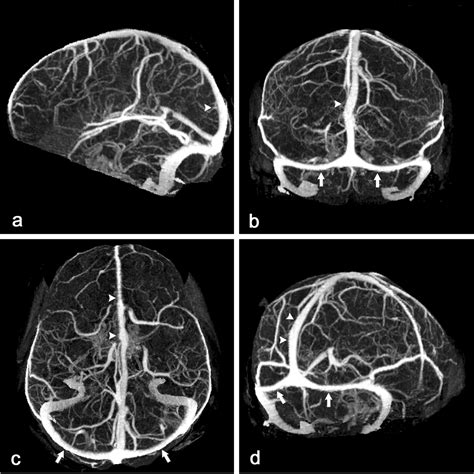 Fig 1 Multisection Ct Venography Of The Dural Sinuses And Cerebral