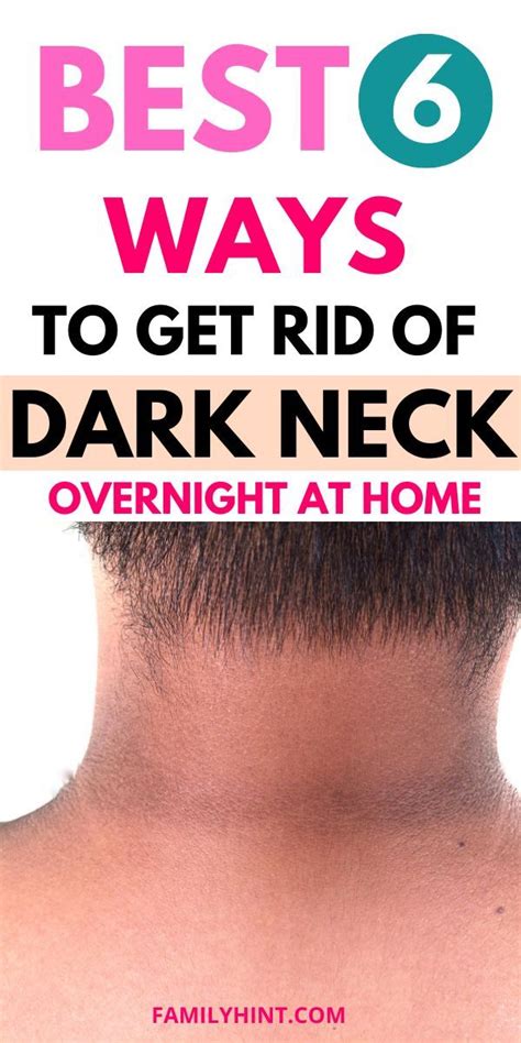 How To Get Rid Of Dark Neck At Home 6 Natural Remedies In 2023