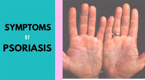 The Symptoms Of Psoriasis Skinny Shiny