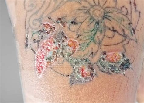 Skin Reactions To Tattoos Johns Creek Dermatology Md