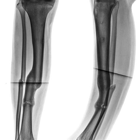 Pdf Case 11 Sixteen Year Old Male With Tibial Malunion Complicated