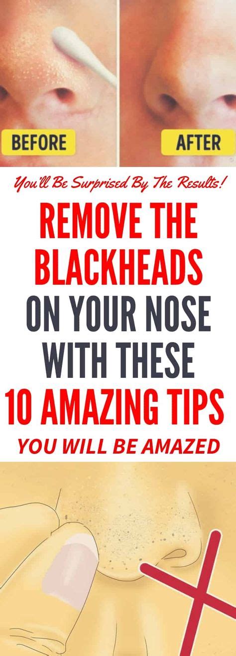 Remove The Blackheads On Your Nose With These 10 Amazing Tips