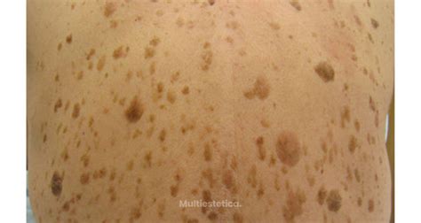 Queratosis Seborreica Causas Y Tratamientos