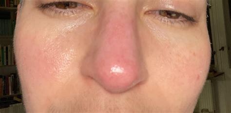 Routine Help Help For A Red Nose Dont Think Its Rosacea