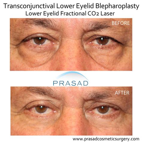 Laser Treatment For Dark Circles Under Eyes Dr Prasad Blog