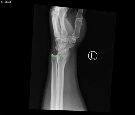 Case Report Of Distal Radioulnar Joint And Posterior Elbow Dislocation