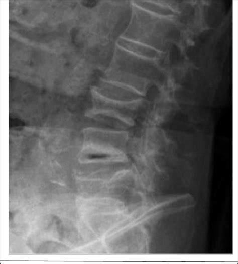 A Plain Lateral Radiograph Of An Osteoporotic Vertebral Compression