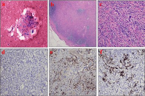 A Pleural Fluid Cytology Showing Few Atypical Cells With Large