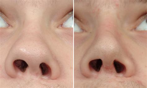 Unilateral Cleft Rhinoplasty Result Submental Bview Dr Barry Eppley