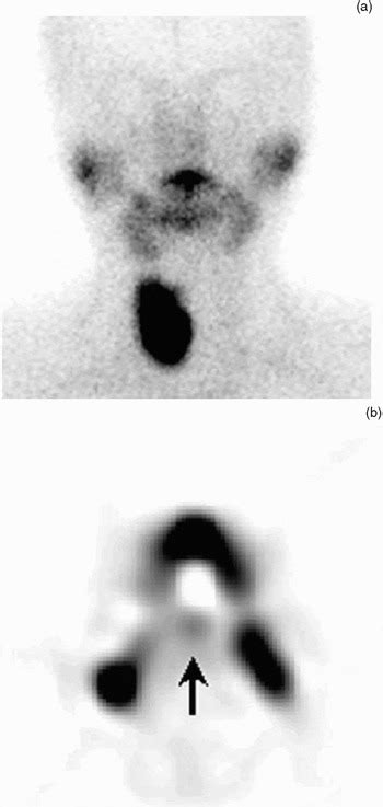 Case Of Thyroid Hemiagenesis And Ectopic Lingual Thyroid Presenting As