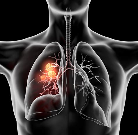 Advanced Lung Imaging Magnetic Resonance Imaging And Artificial