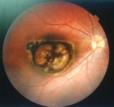 Right Eye Coloured Fundus Photograph Tilted Optic Disc Macular With A