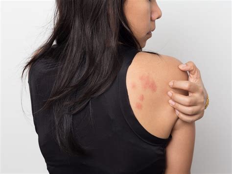 How To Recognize And Treat Stress Rashes And Hives According To